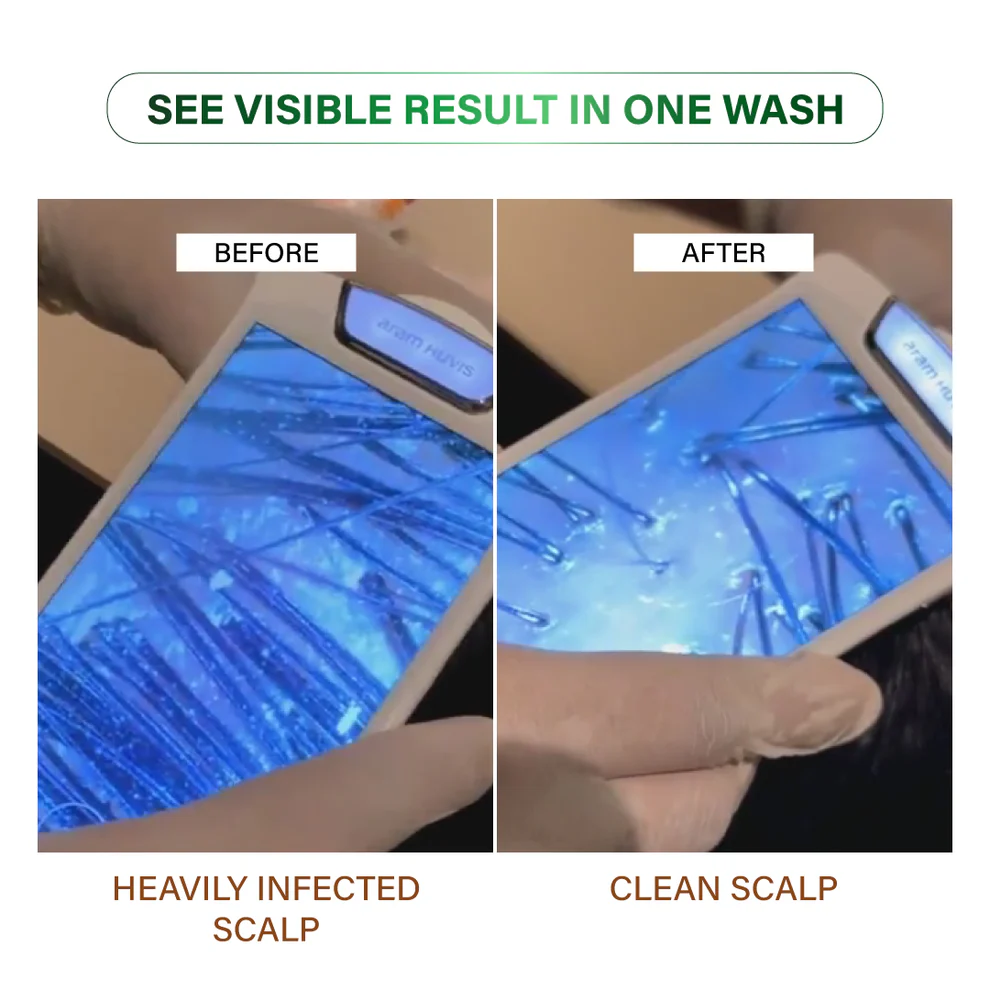 Dandruff Control Before After